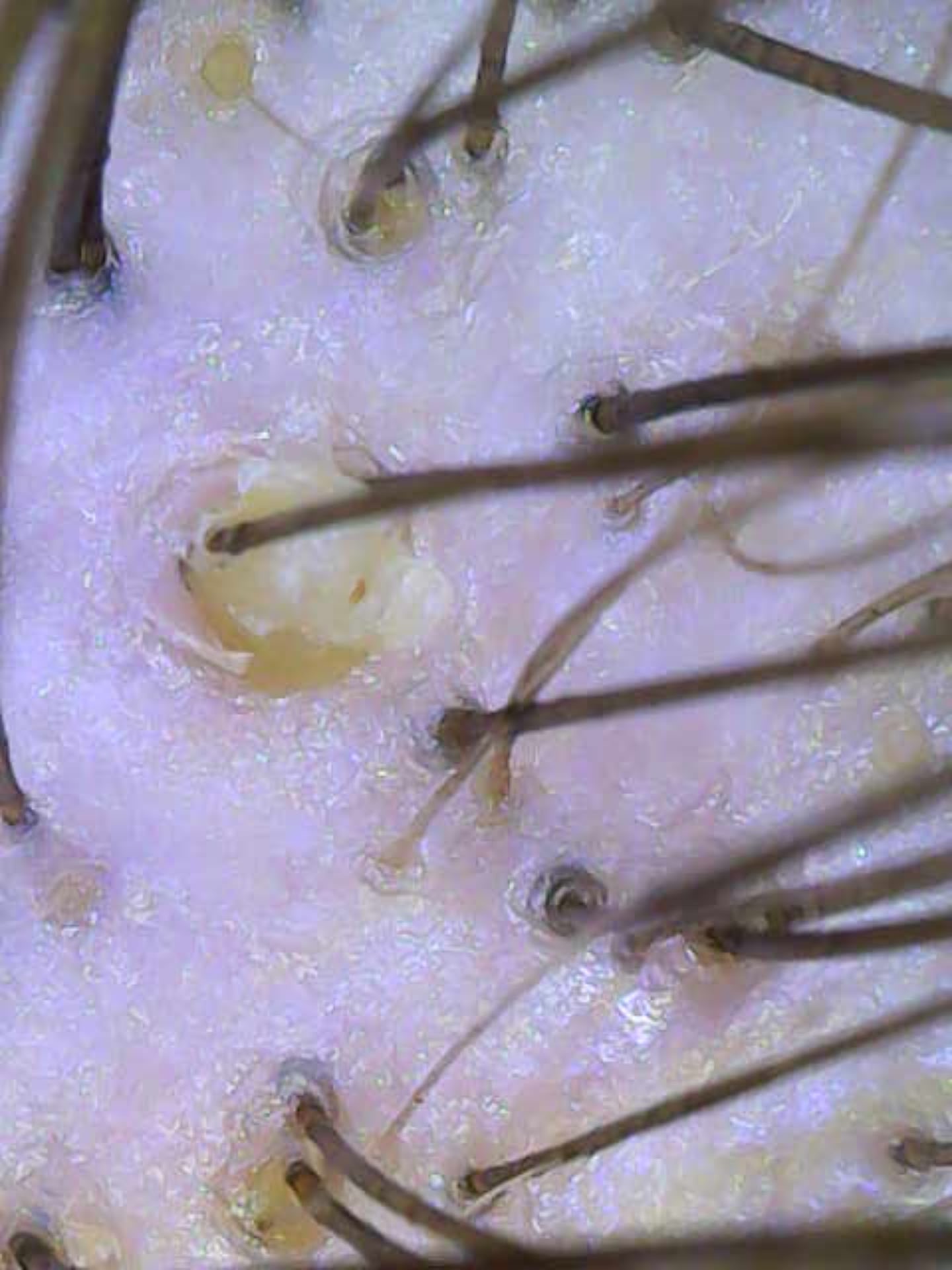 Vorher: seborrhoische Dermatitis